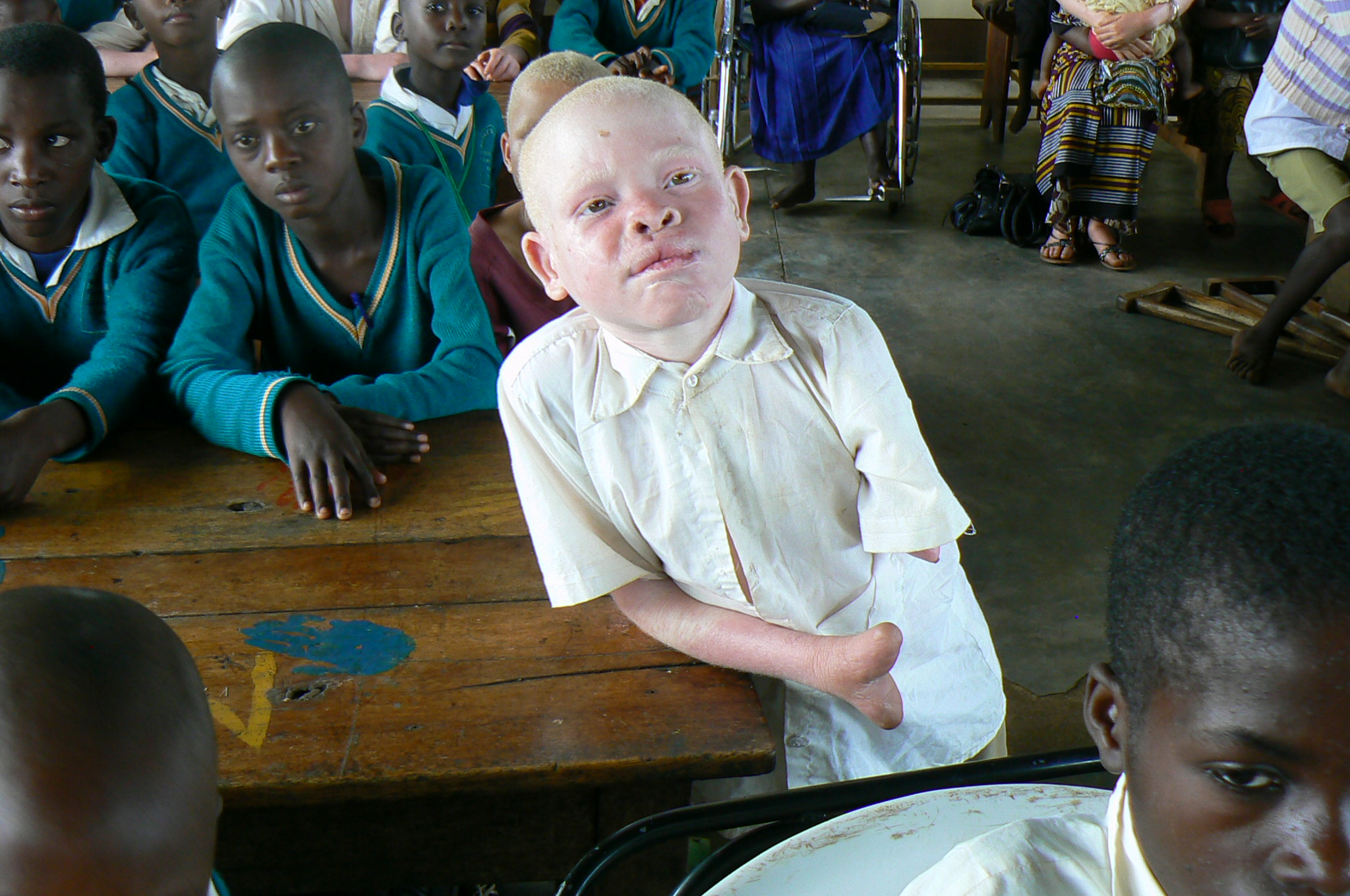 Как люди рождаются альбиносами. Альбиносы африканцы Танзания. Альбинизм негроидная раса.